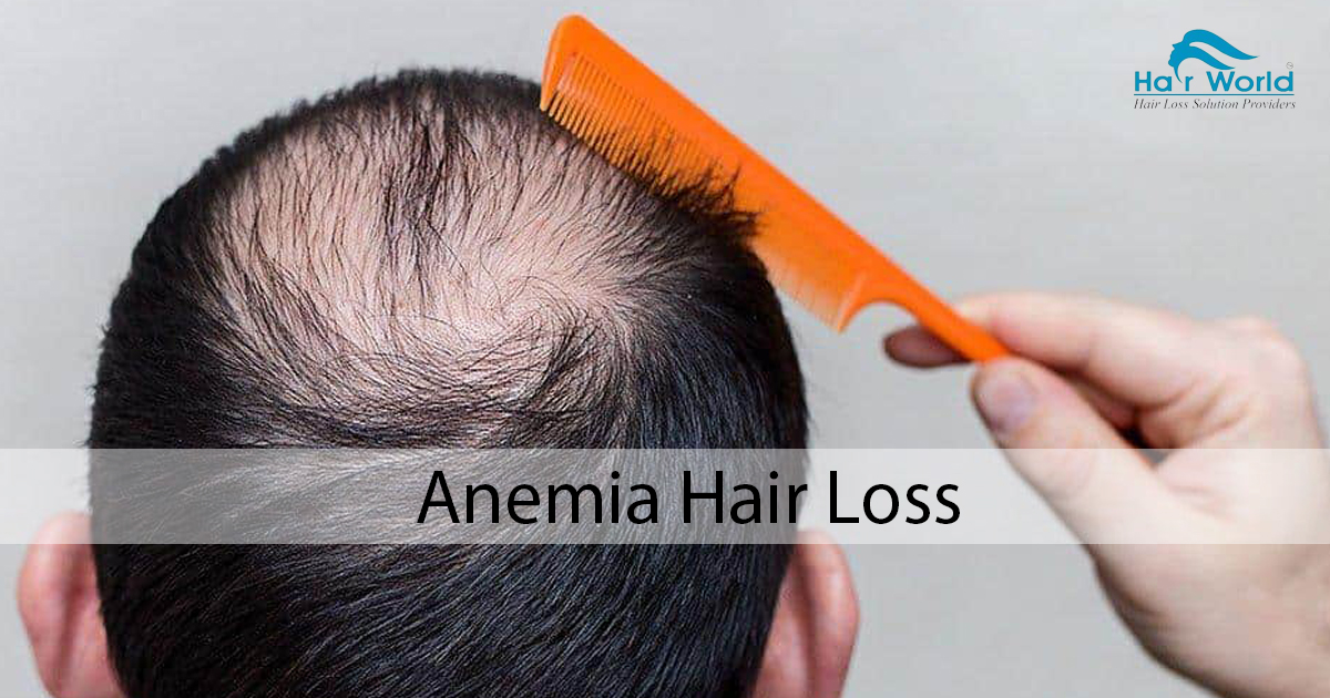 Anemia Hair Loss